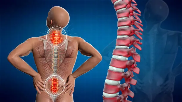 Ilustración médica detallada de una protrusión en la columna lumbar afectando nervios periféricos