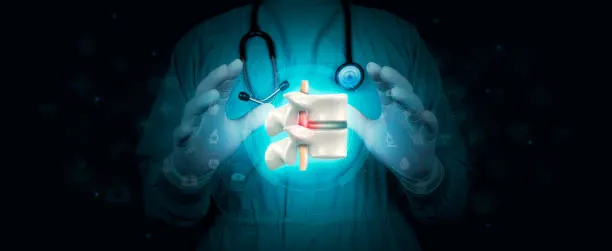 Representación médica de compresión nerviosa causada por desplazamiento vertebral conocido como hernia de disco