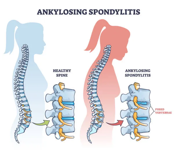 Diagrama comparativo de postura corporal mostrando diferencias entre una espalda sana y otra con spondylitis