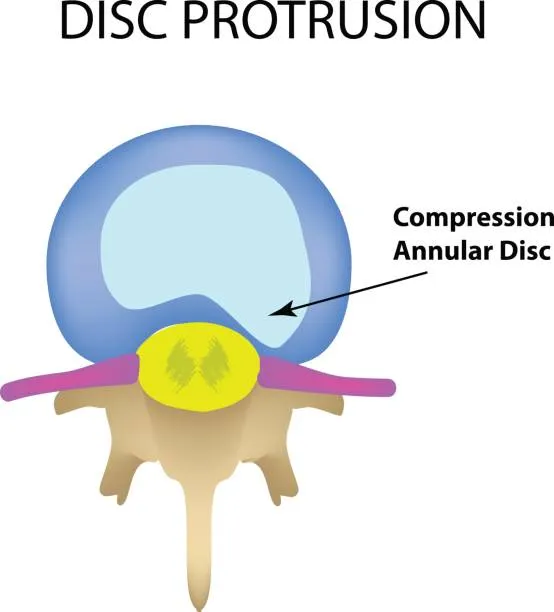 Imagen ilustrativa de un disco intervertebral con protusion discal, mostrando cómo el material discal sobresale y genera presión que puede causar dolor, limitación de movimiento y malestar.