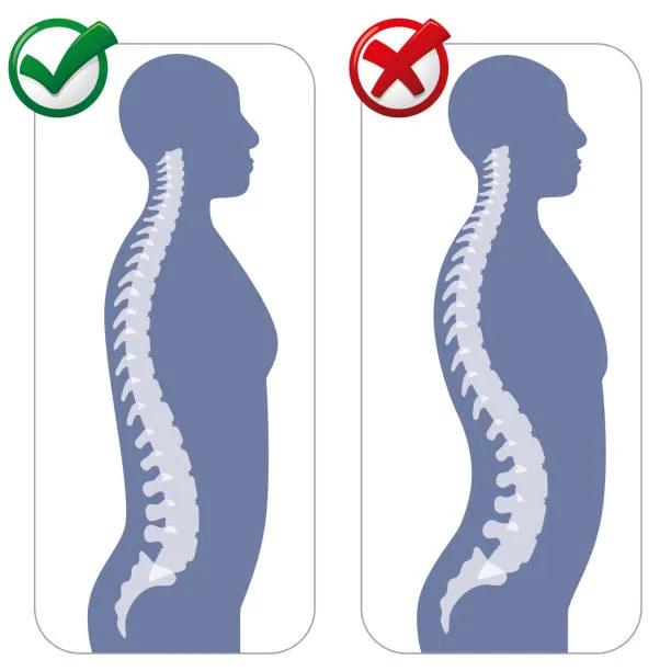 Imagen comparativa de hombre con postura correcta y columna alineada versus columna incorrecta, representando distintos tipos de lumbalgia