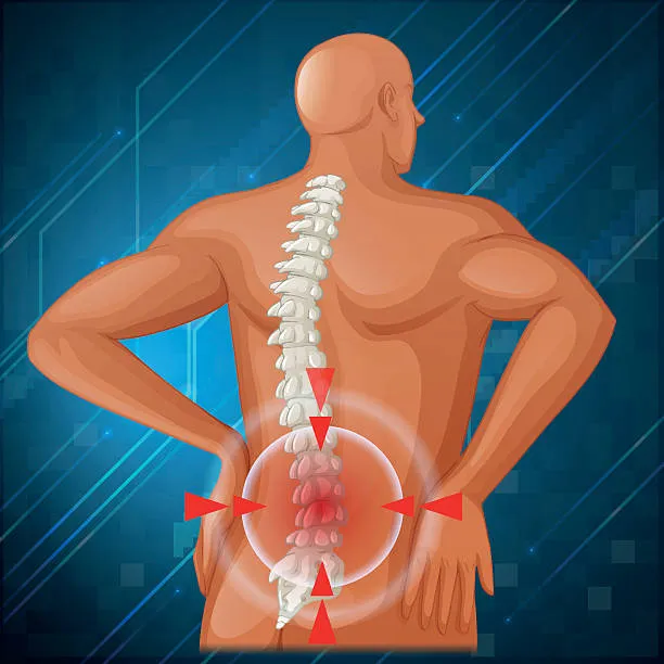 Representación de hombre con dolor lumbar en zona baja, indicando un caso frecuente dentro de los tipos de lumbalgia y su impacto funcional