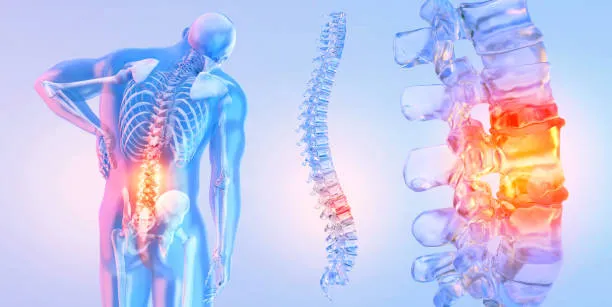 Radiografía de columna con signos de degeneracion discal, mostrando desgaste en los discos que provoca dolor y reduce flexibilidad en la espalda de un hombre.