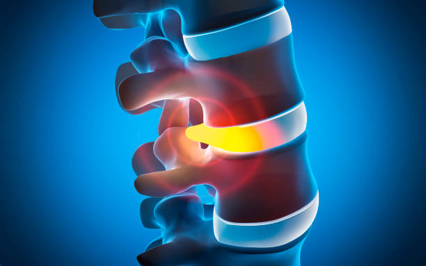 verdades sobre hernia discal y opciones sin cirugía