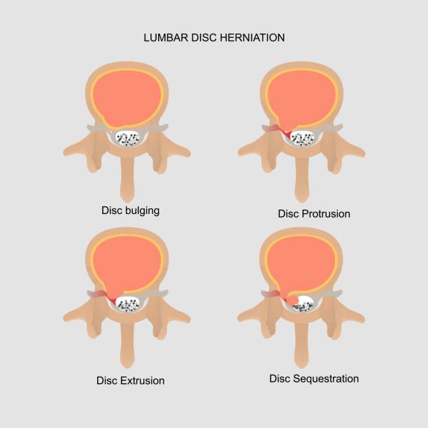 4 tipos de hernias discales con disco extruido presionando un nervio
