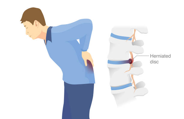 4 tipos de hernias discales mostrando discos degenerativos y protruidos en la columna