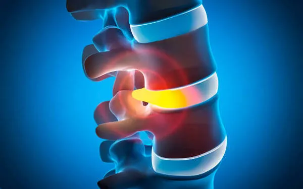 hernia de disco con desplazamiento y compresión nerviosa