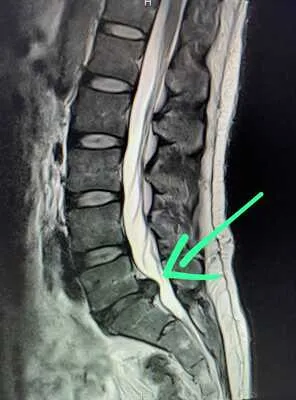 esclerosis espalda con dolor muscular y tratamiento no invasivo